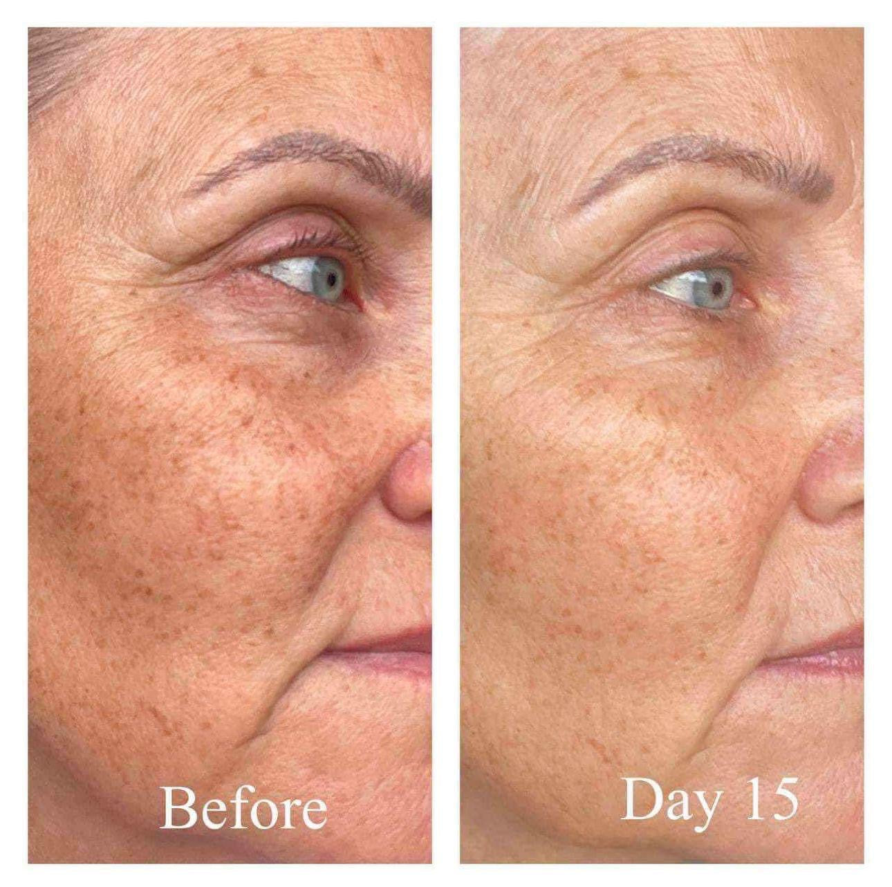 Before and after comparison of a woman's face with visible skin texture changes over 15 days.